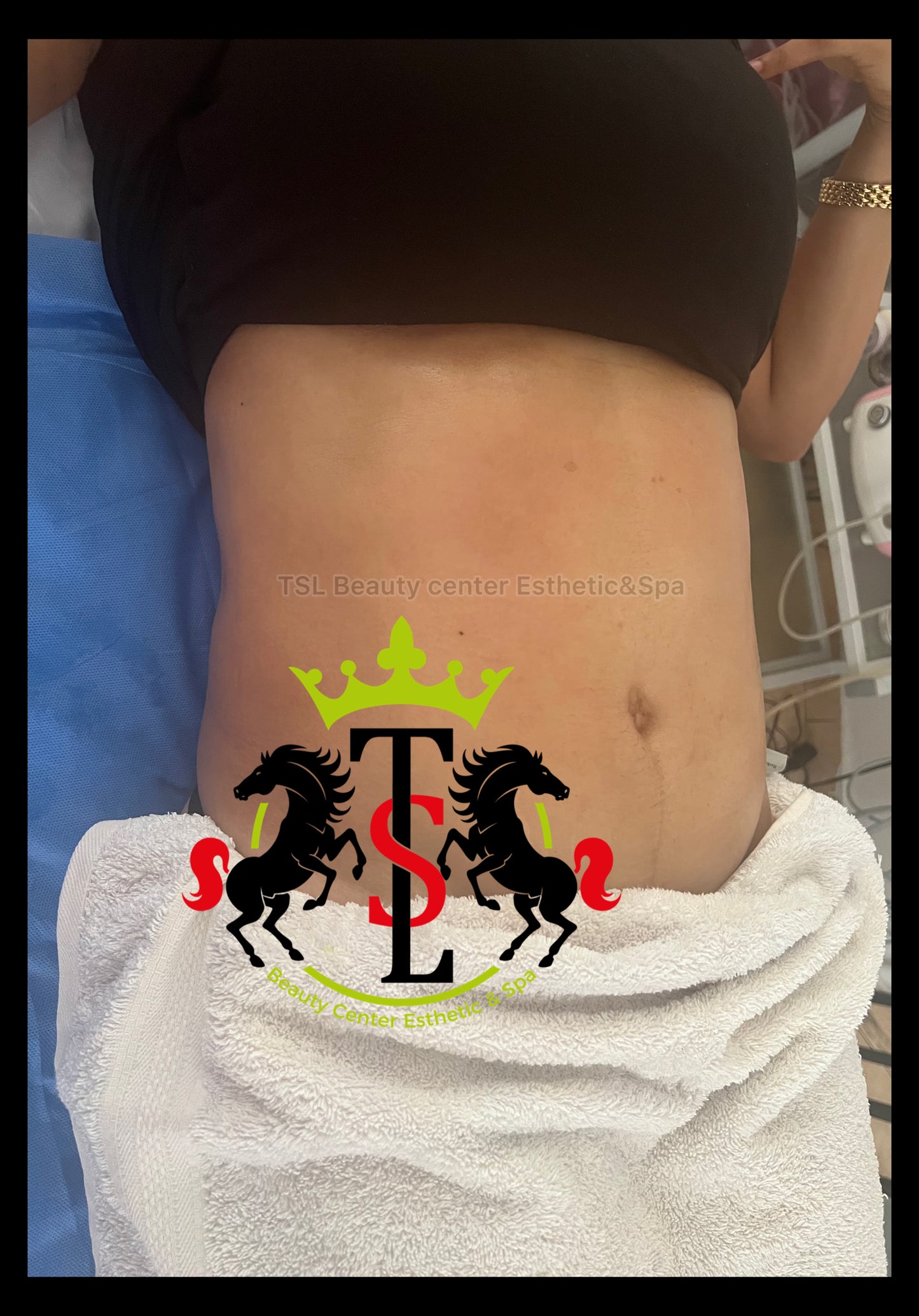 Package Body Sculpting Fat Removal