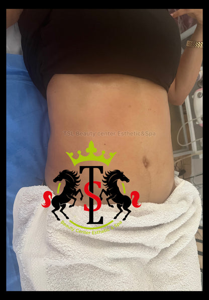 Package Body Sculpting Fat Removal