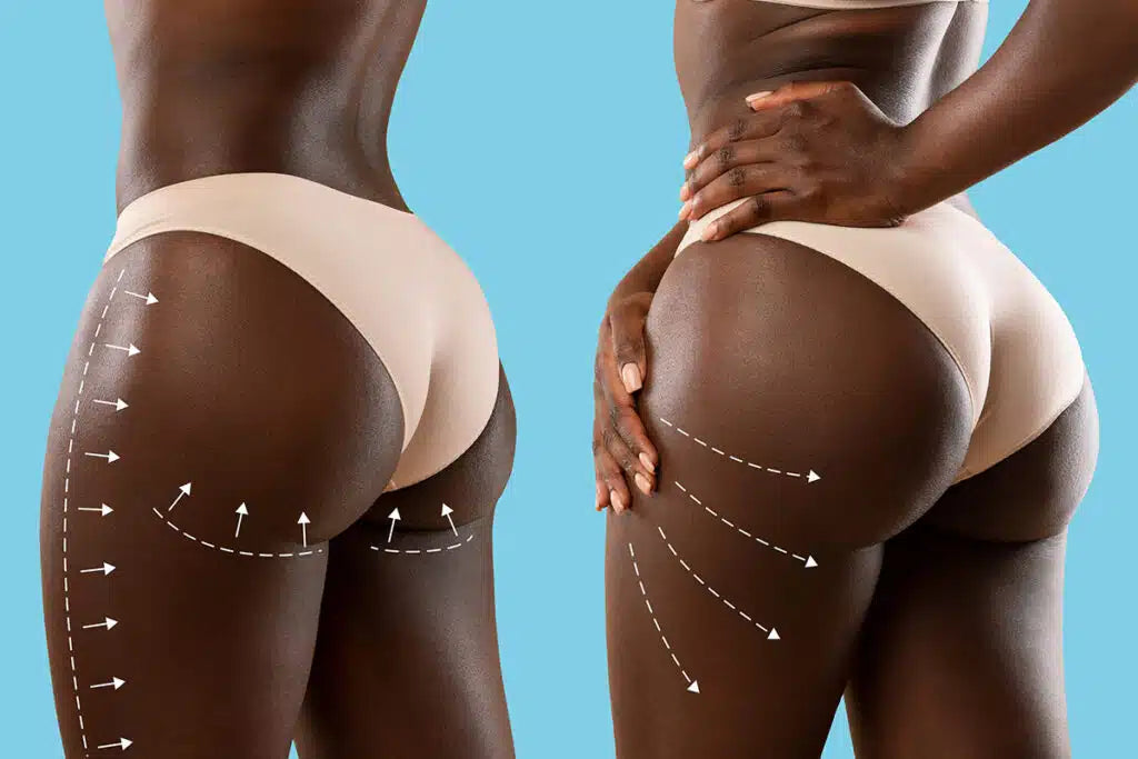 Non-Surgical Butt Lift