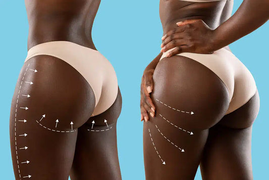 Non-Surgical Butt Lift